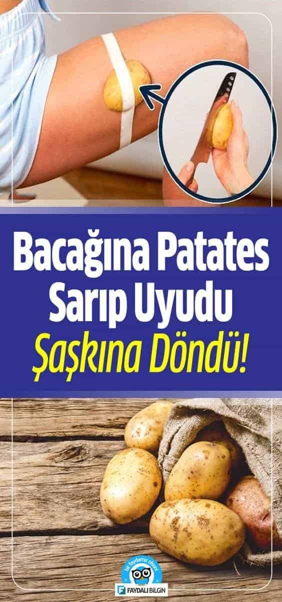Bacağına Patates Sarıp Uyudu 1 Saat Sonra Şaşkına Döndü!
